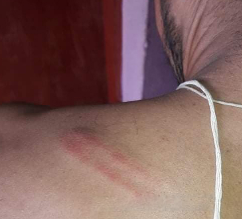 धरानका एक स्वास्थ्यकर्मीमाथि प्रहरीद्धारा कुटपिट, विरोधमा स्वास्थ्य संथाहरु बन्द