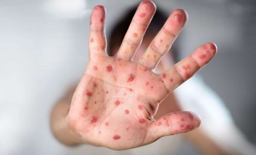 दादुरा–रुबेलाविरुद्धको खोप अभियान आजदेखि देशभर सुरु