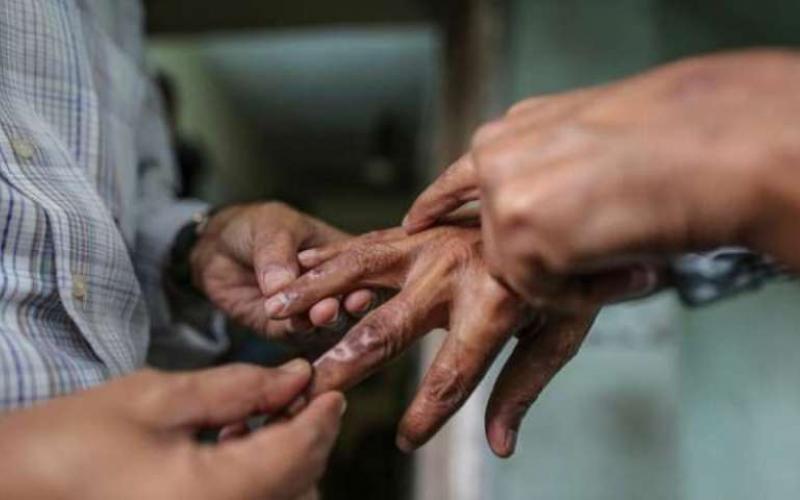 काठमाडौँ महानगरपालिकामा ११० कुष्ठरोगका बिरामी फेला