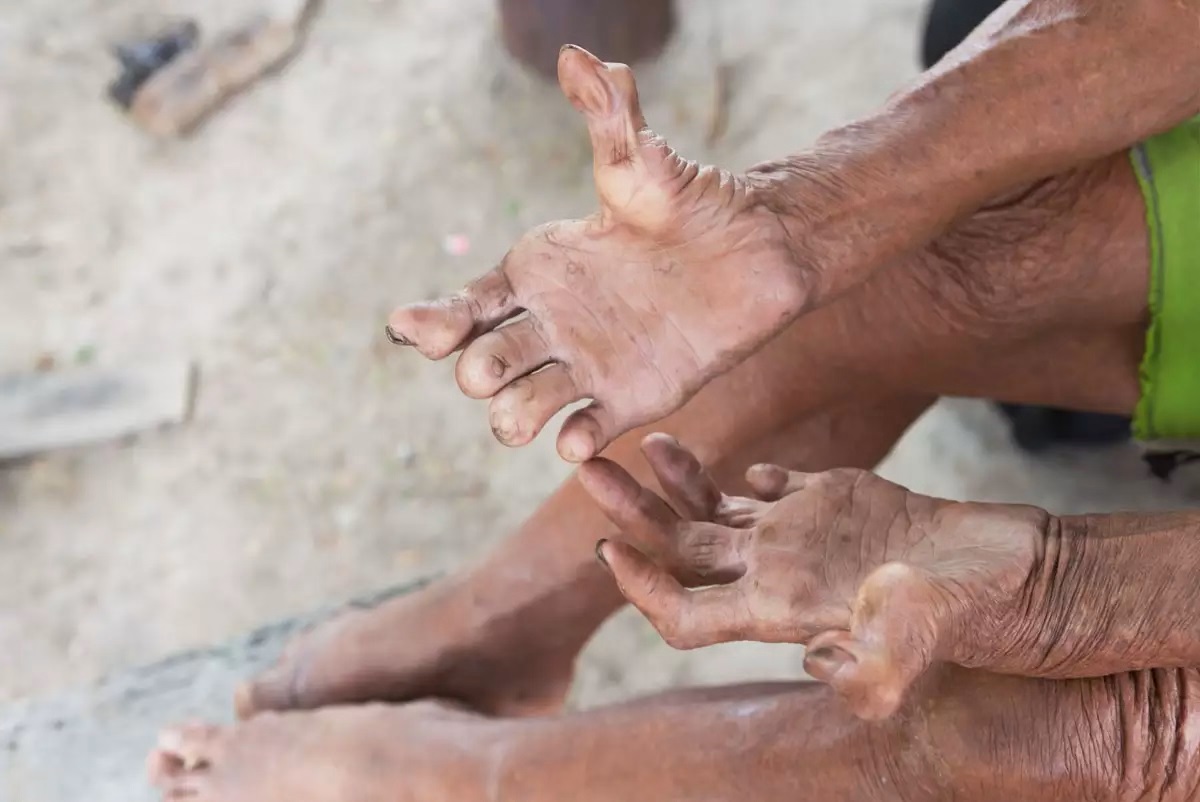 बिर्तामोड नगरपालिकामा कुष्ठरोगीको संख्या १ सय ११ पुग्यो